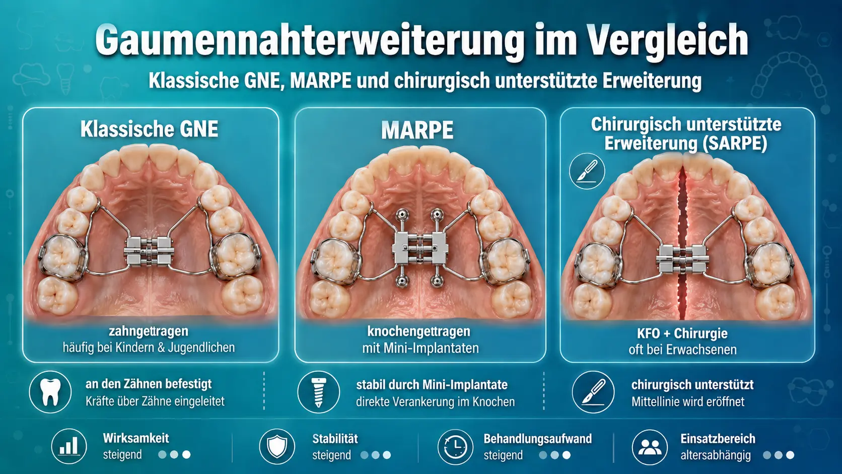 Vergleich klassische Gaumennahterweiterung, MARPE mit Mini-Implantaten und chirurgisch unterstützte Erweiterung