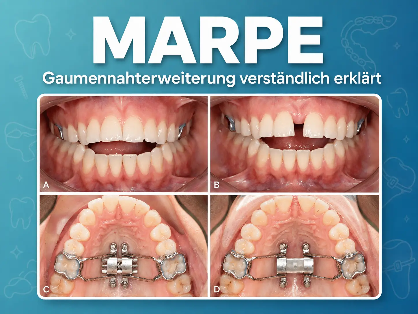 MARPE-Apparatur mit Miniimplantaten im Gaumen zur Oberkiefererweiterung bei Erwachsenen in Zürich