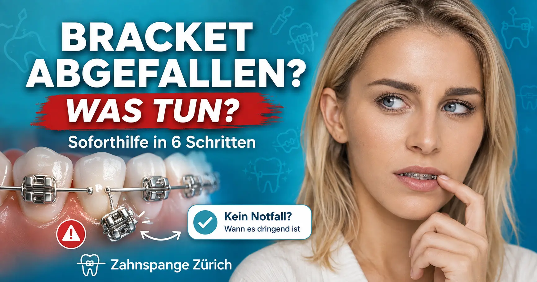 Bracket abgefallen – was tun? Soforthilfe in 6 Schritten Bracket von der festen Zahnspange abgefallen: Ruhe bewahren, störende Stellen schützen und die Kieferorthopädie kontaktieren.