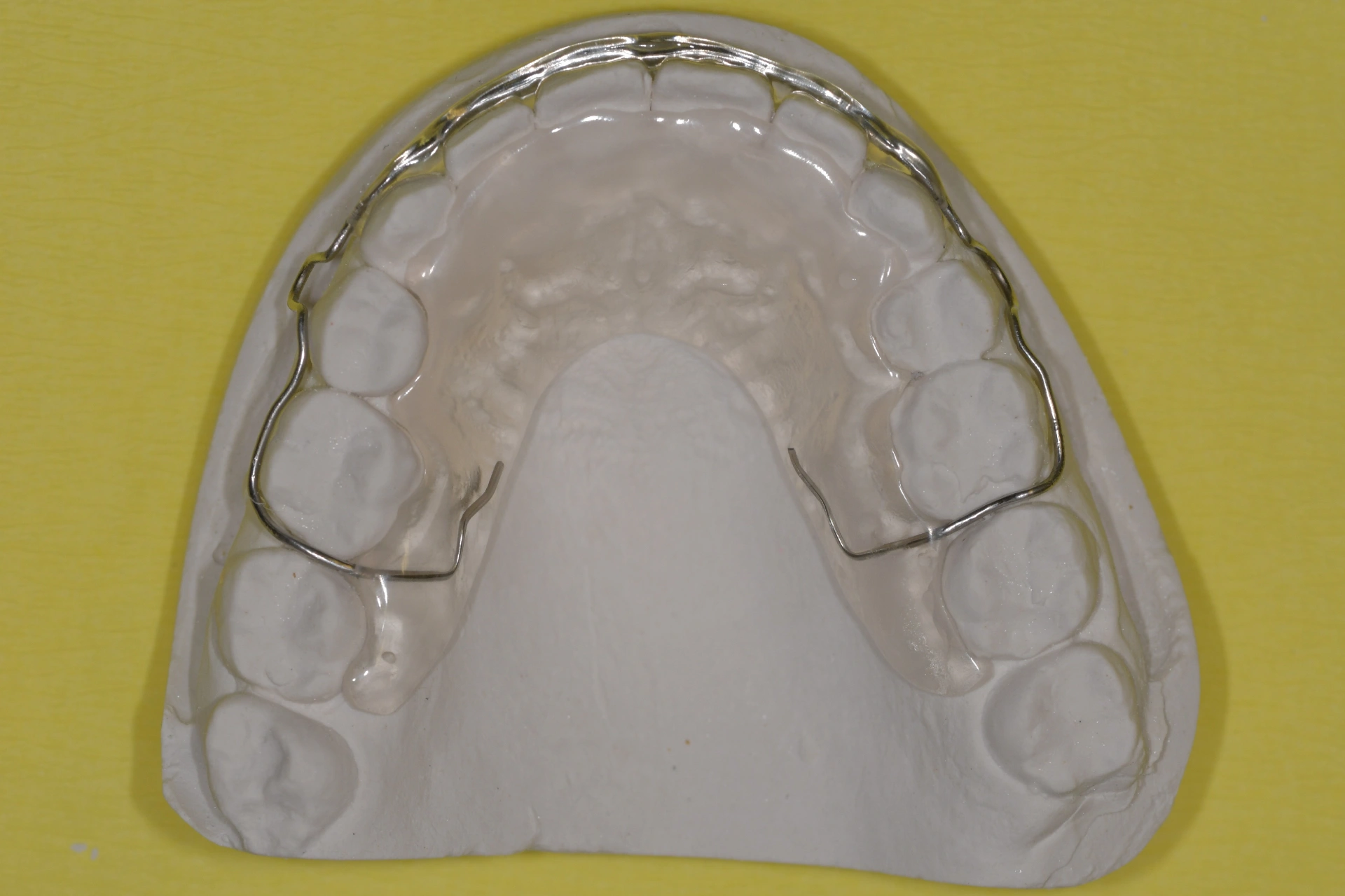 Hawley-Retainer auf einem Oberkiefermodell Hawley-Retainer auf einem Oberkiefermodell mit Kunststoffbasis und Metalldraht zur Stabilisierung der Zähne.
