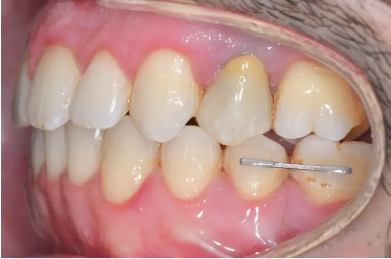 Nachher-Bild einer Dysgnathie-Behandlung mit Keramik-Zahnspange, Lückenschluss im Unterkiefer und Implantat im Oberkiefer