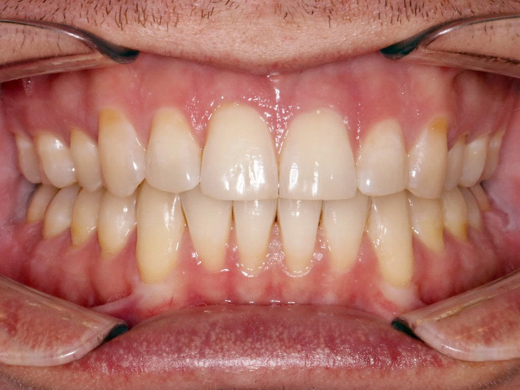 Nachher-Bild nach 14 Monaten Lingualtechnik WIN mit geschlossenem offenen Biss bei erwachsenem Patienten