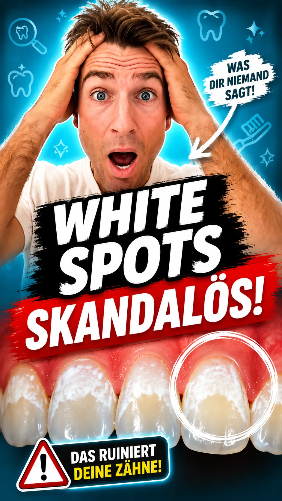 White Spots auf den Zähnen: Kreidig-weisse Flecken können auf eine Entmineralisierung des Zahnschmelzes hinweisen.