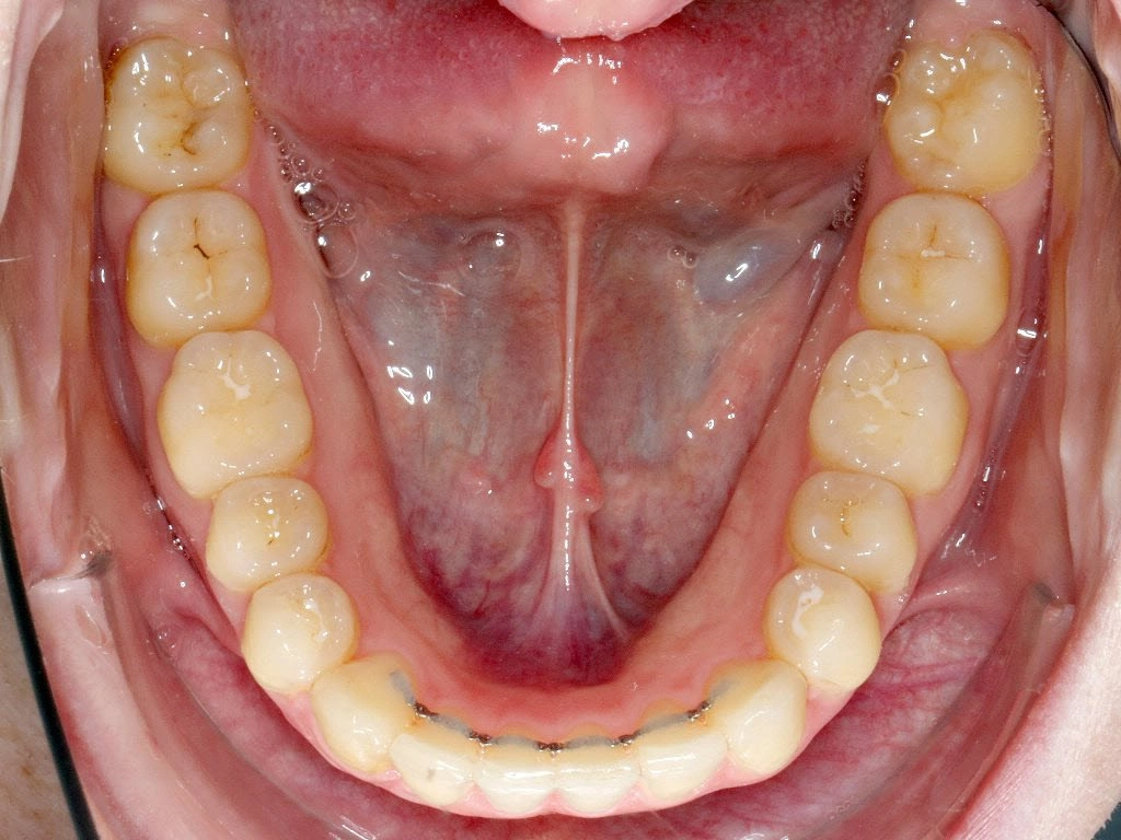 Nachher-Bild des Unterkiefers nach 10 Monaten Aligner-Behandlung zur Korrektur eines X-Effekts bei erwachsener Patientin