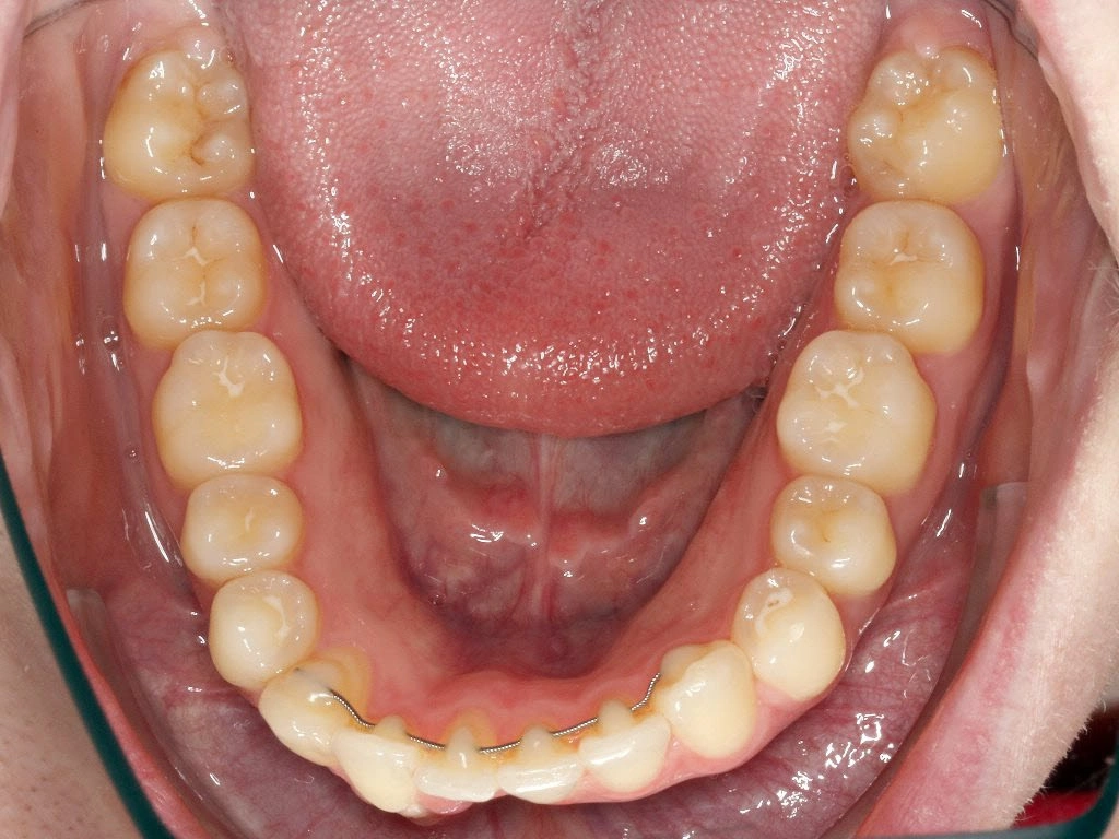 Vorher-Bild des Unterkiefers mit X-Effekt und Engstand vor Aligner-Behandlung bei erwachsener Patientin in Zürich