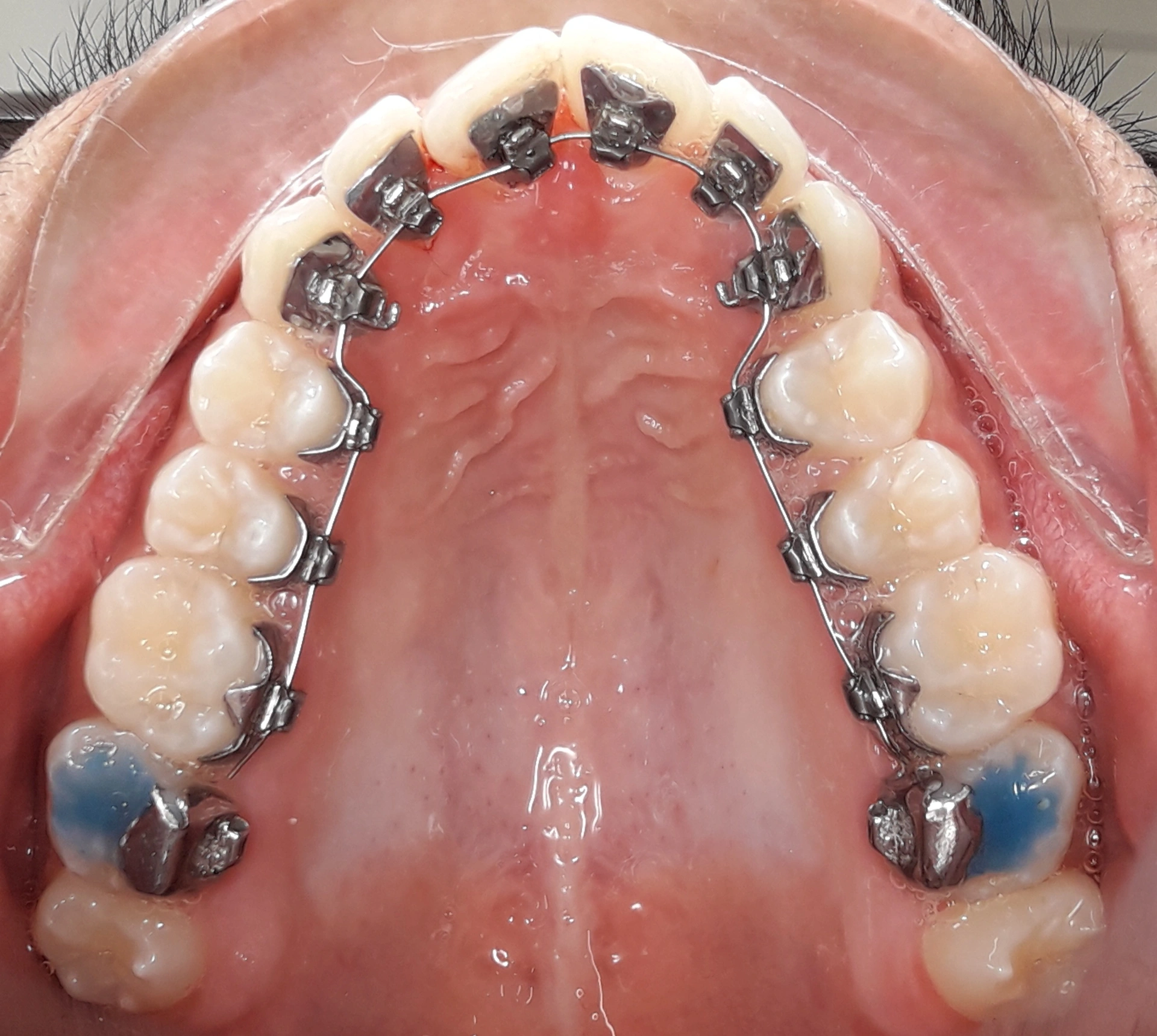 Innenliegende Zahnspange (Lingualzahnspange) im Oberkiefer mit Brackets auf der Innenseite der Zähne